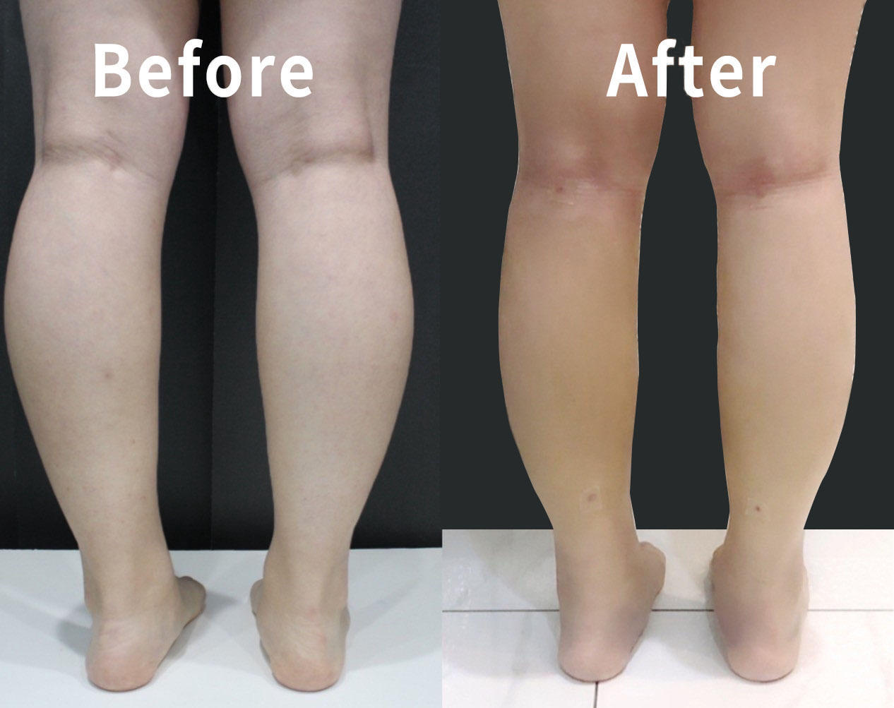 脂肪填充改善腿型术后，双腿对比 - 美好生活