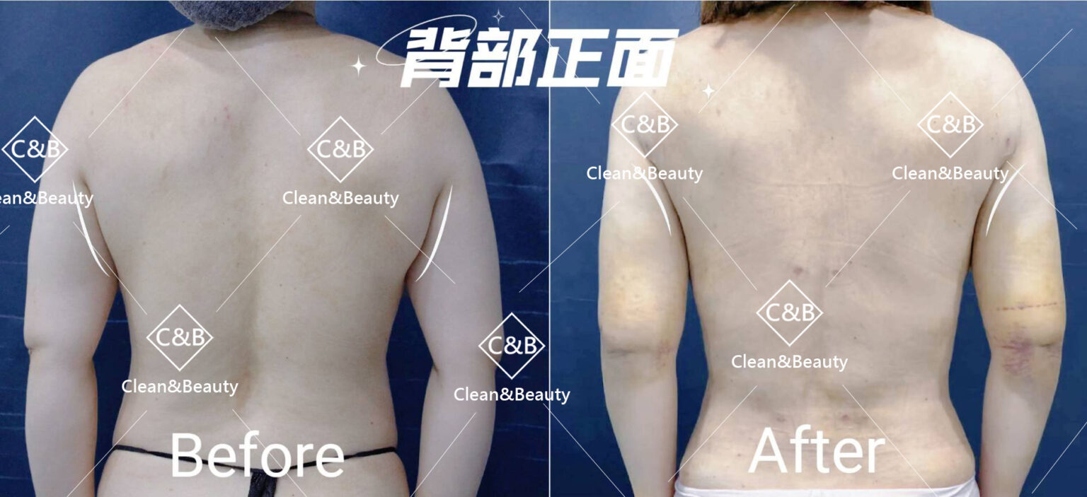 威塑背部抽脂術前術後