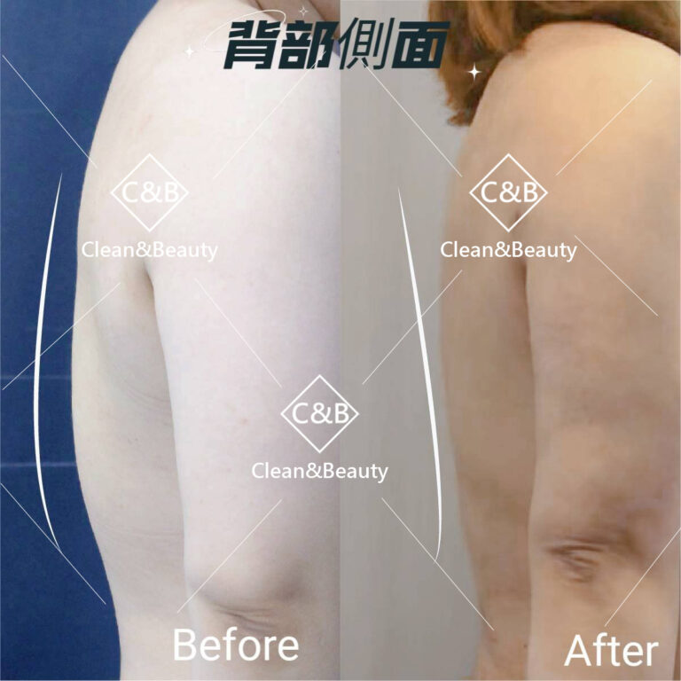 威塑背部抽脂術前術後(側面)