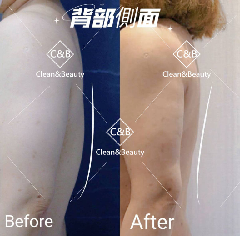 威塑背部抽脂術前術後(側面)
