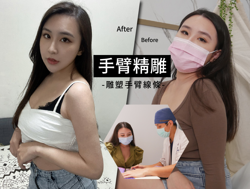 威塑手臂抽脂案例
