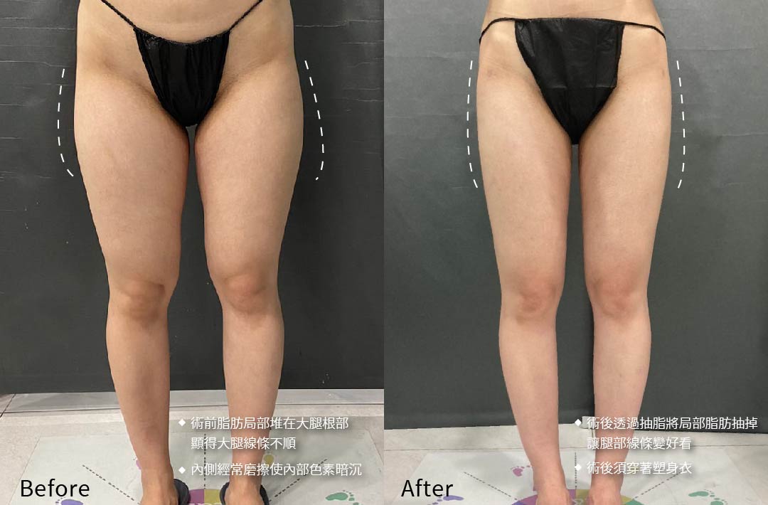 威塑抽脂 大腿抽脂術前術後