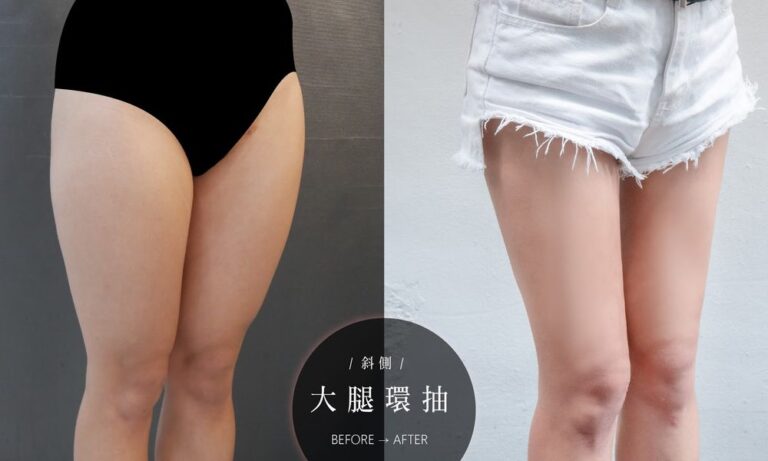 抽脂案例介紹-una術前術後